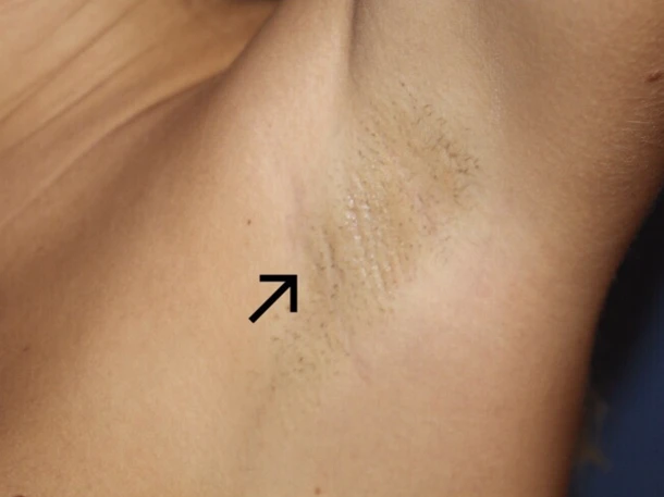 Brystforstørrelse via armhulen - transaxsillar tilgang 