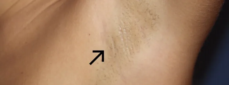 Brystforstørrelse via armhulen - transaxsillar tilgang 