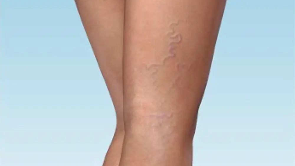 lei-av-synlige-blodaarer-paa-ben