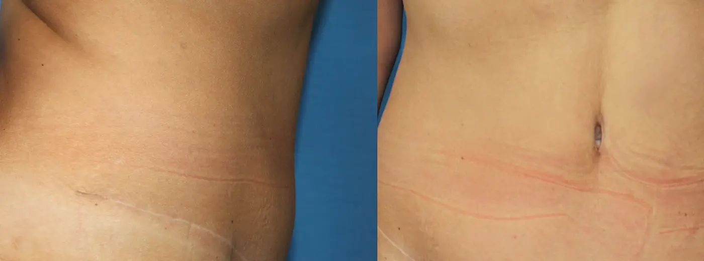 Mageplastikk etter vekttap