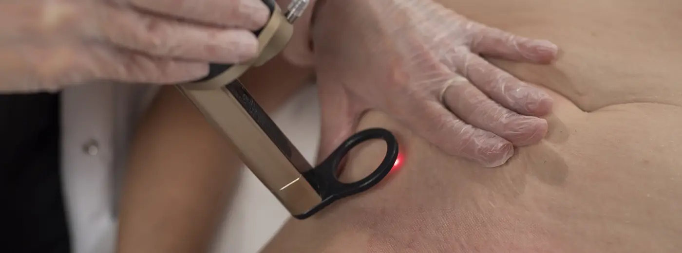 Laserbehandling av arr etter kirurgi